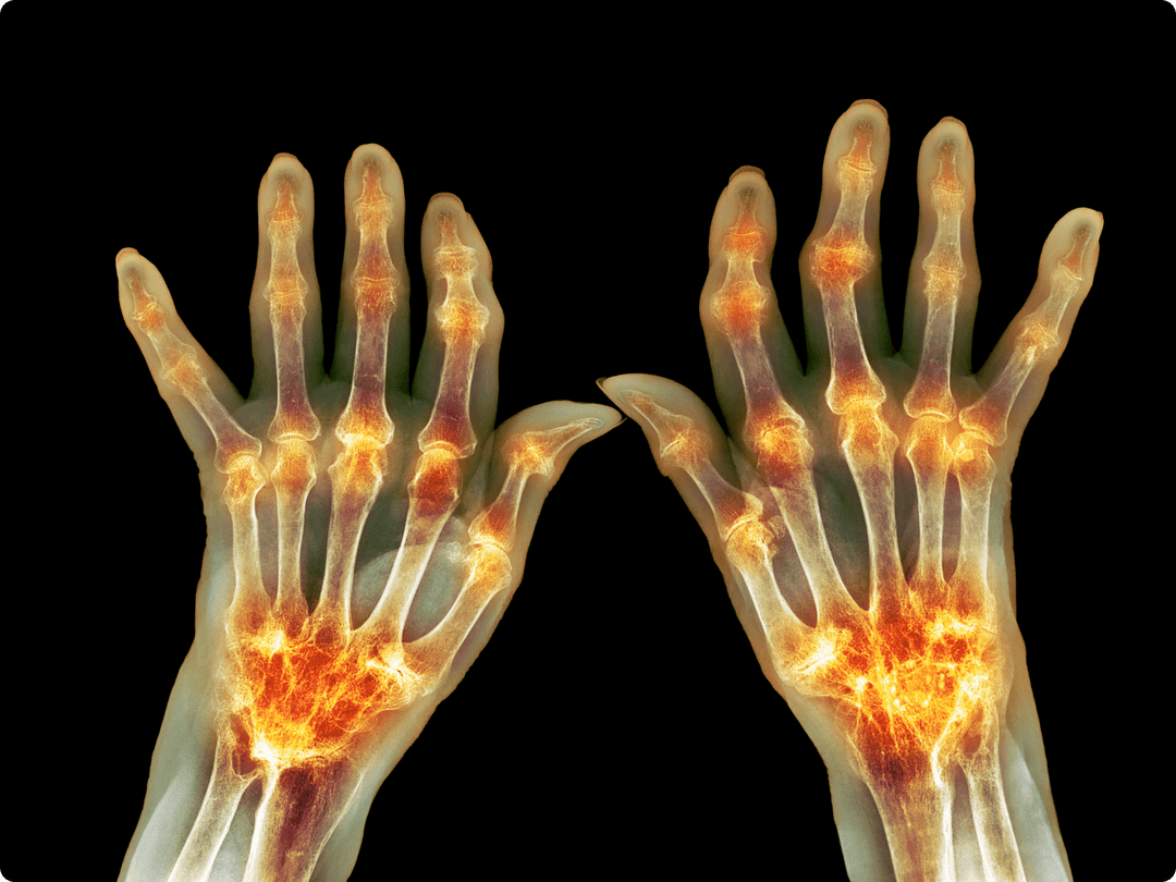 Arthritis und Gelenkentzündungen